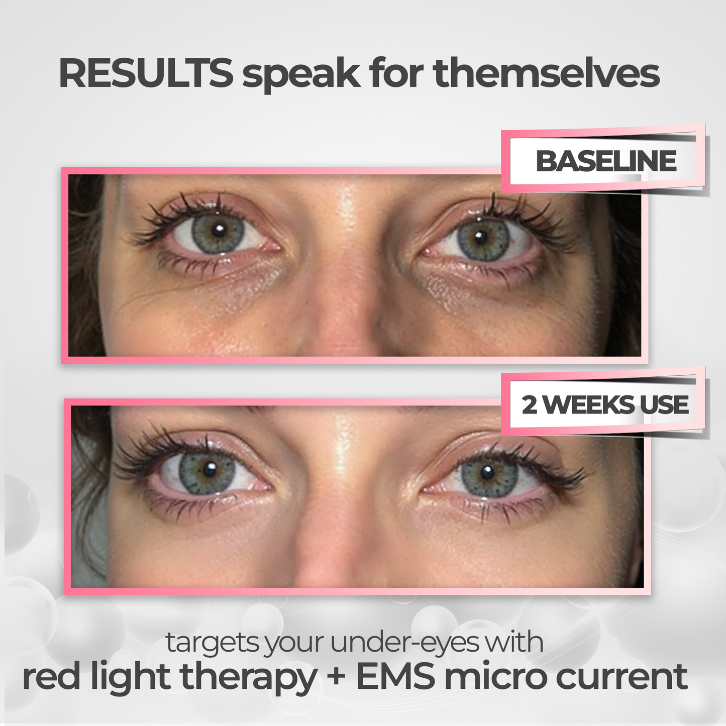 RevitalEyes™ 2-in-1 Red Light + EMS Eye Bag Therapy