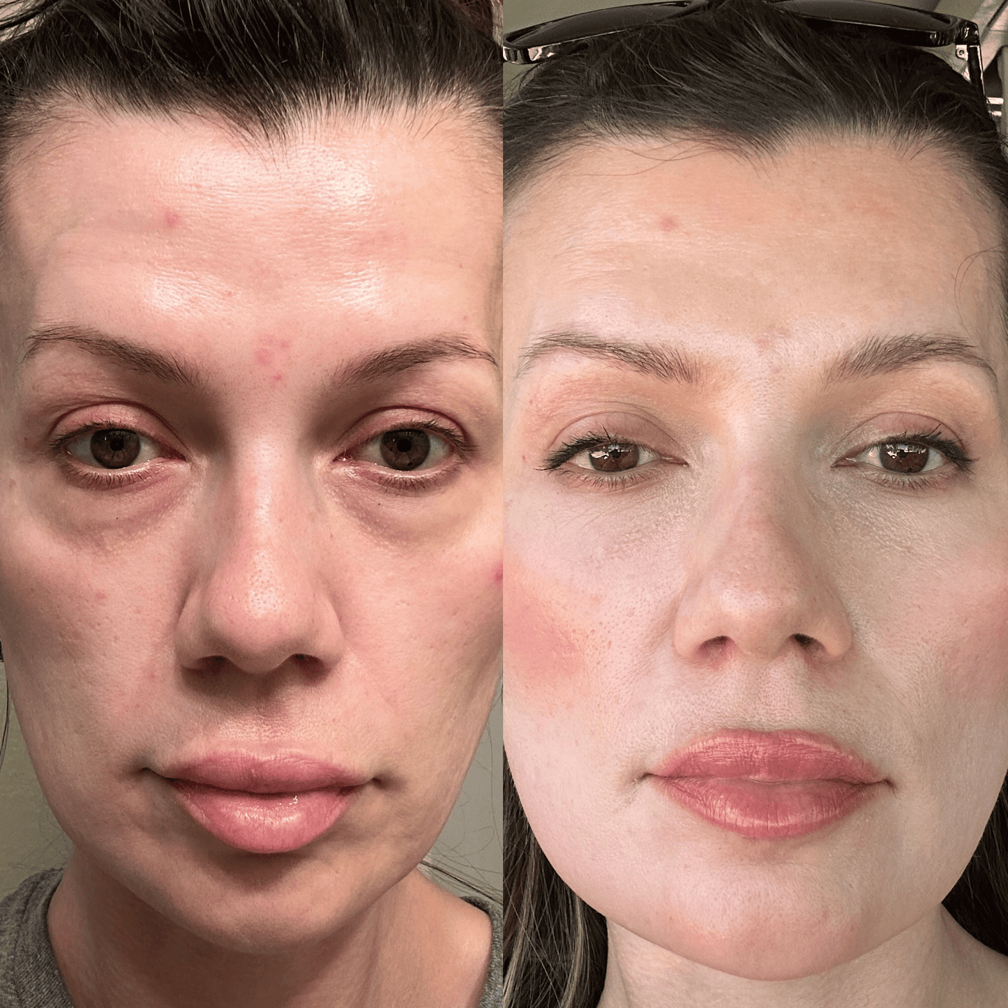 RevitalEyes™ 2-in-1 Red Light + EMS Eye Bag Therapy
