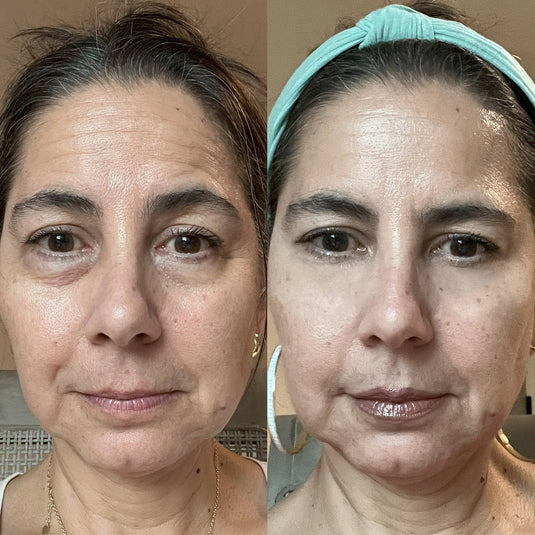 RevitalEyes™ 2-in-1 Red Light + EMS Eye Bag Therapy