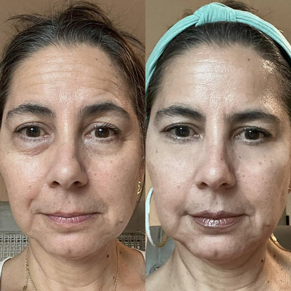 RevitalEyes™ 2-in-1 Red Light + EMS Eye Bag Therapy